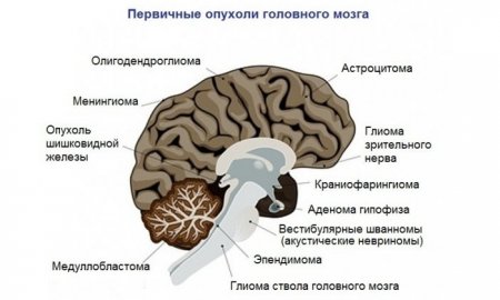 Первые признаки и симптомы опухоли головного мозга